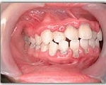 歯石除去　術前