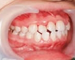 歯石除去　術後